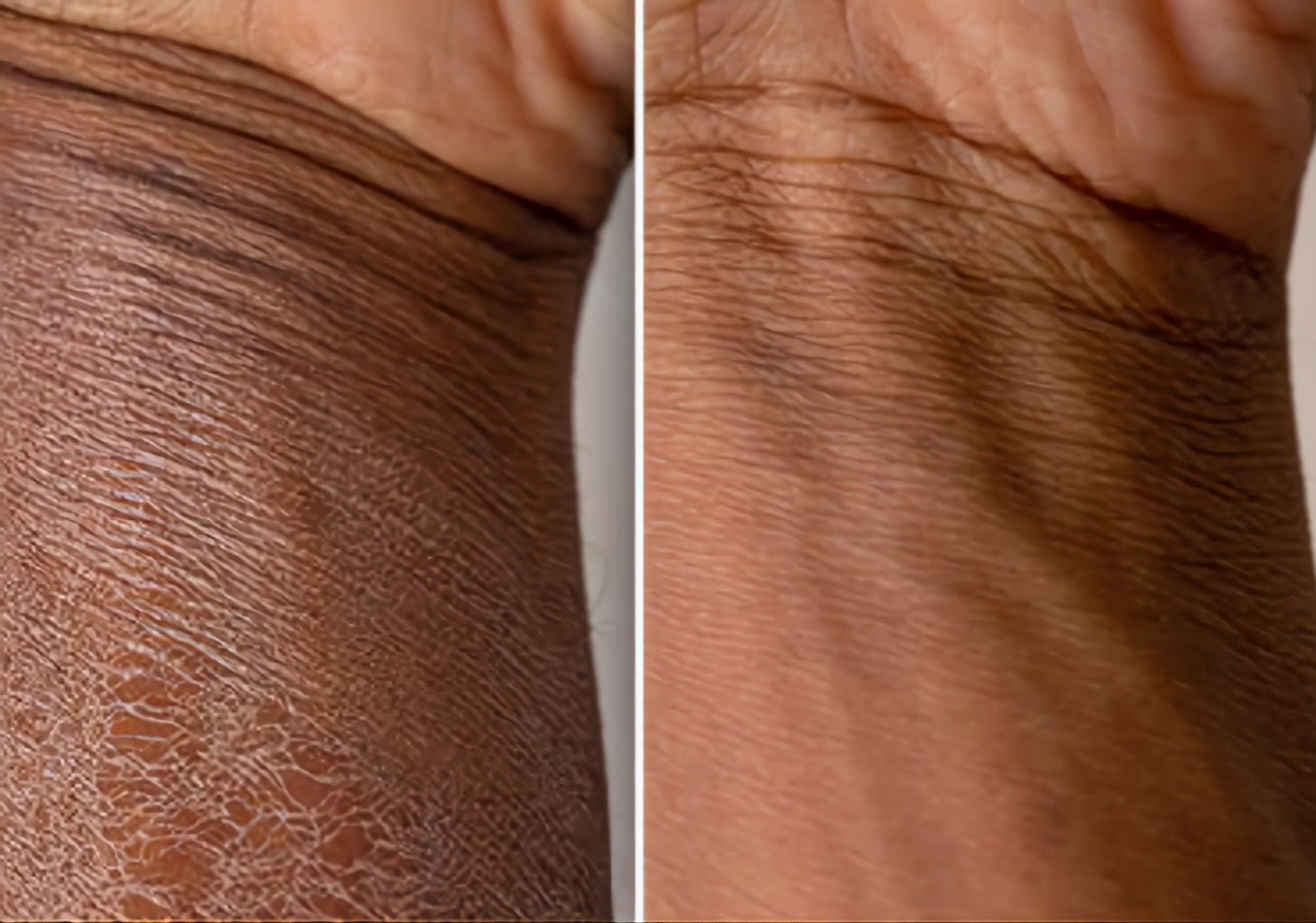 Strawberry Body Butter: Hydrates Dry Eczema Skin. Before & After. My Natural Butter. Mississippi Handmade Moisturizer.